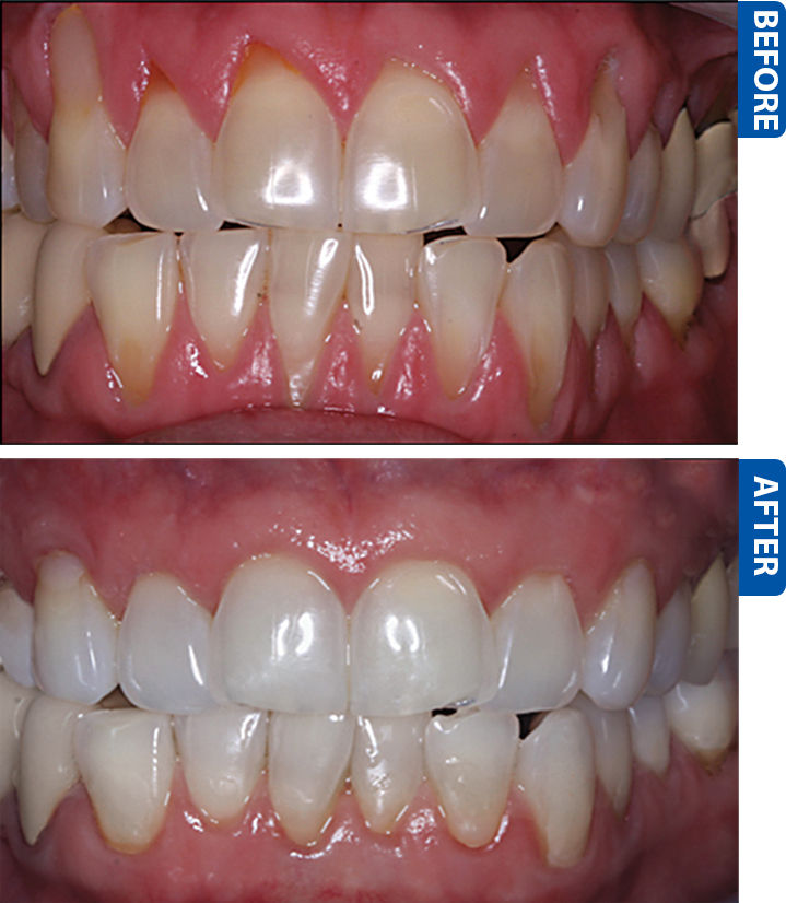 gum recession before after