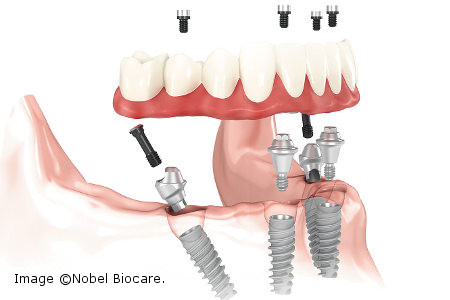 Hybrid Denture Implant