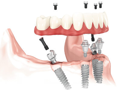 Full Mouth Dental Implants Service