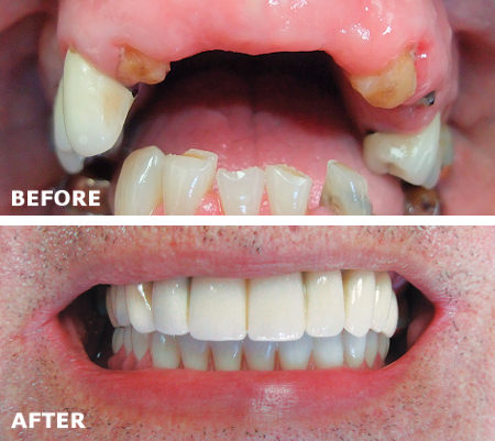 Full Mouth Dental Implants Expert