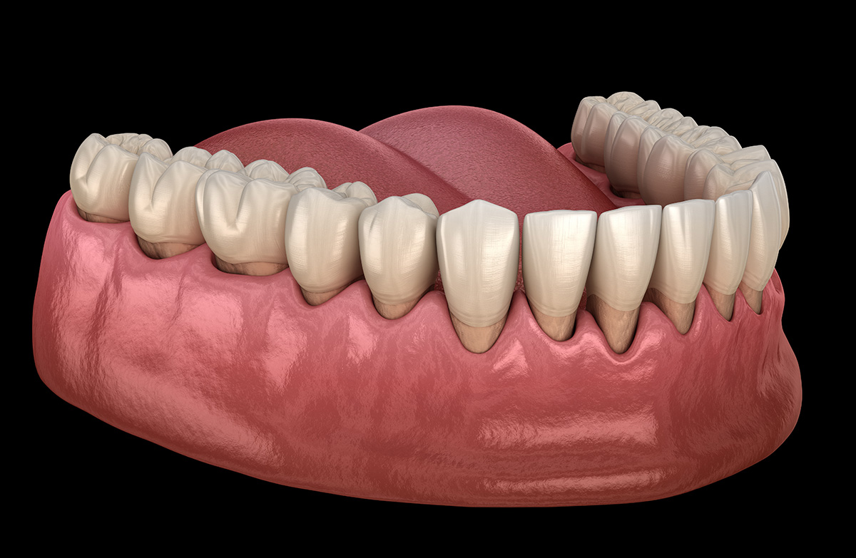 Gum recession 3D model