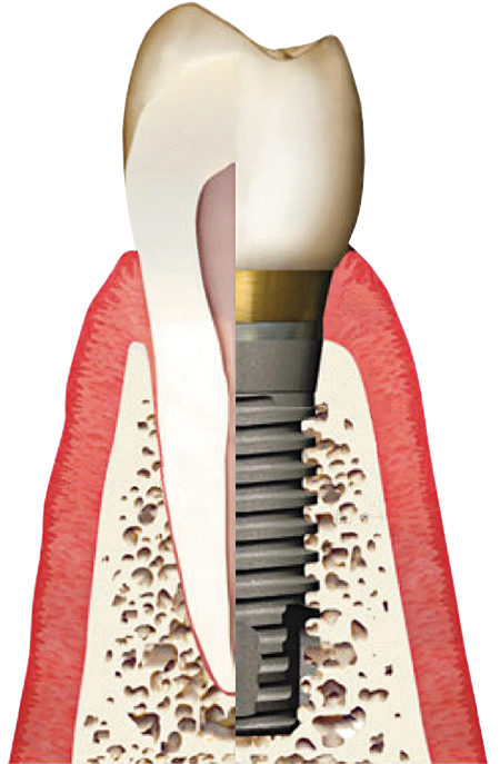 dental implant faqs